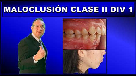 Maloclusion Clase 2 Division 1 De Angle Ortodoncia Youtube