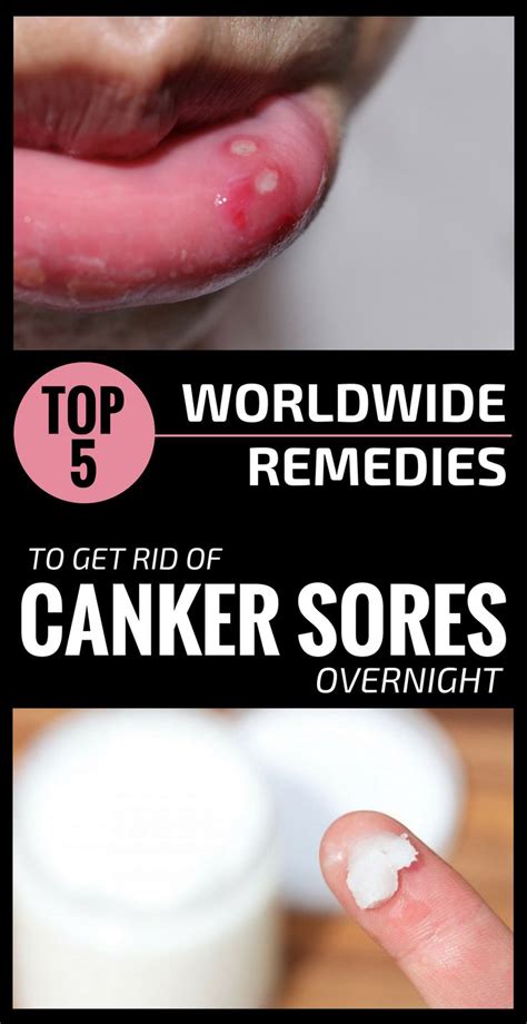 Top 5 Worldwide Remedies To Get Rid Of Canker Sores Overnight Canker