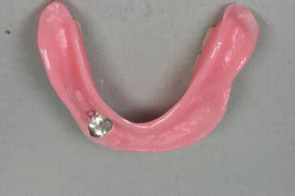Overdenture is any removable dental prosthesis that covers and rests on one or more remaining natural teeth, the roots of natural teeth, and/or dental implants. Prothetikkatalog.de - Cover Denture / Preiswerte ...