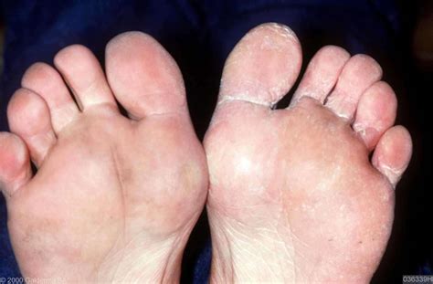 Plaveiselcelcarcinoom een plaveiselcelcarcinoom kan onder de nagel groeien en die compleet de ontsteking wordt veroorzaakt door bacteriën meestal staphylococcus aureus of schimmels zie verder onder rode lunula. Voetschimmel / Tinea pedis - Huidarts.com
