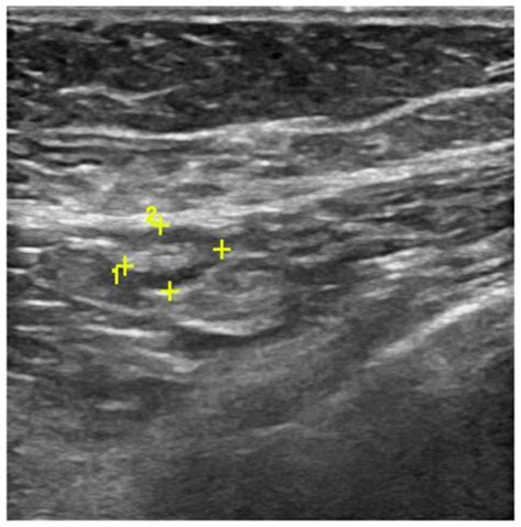 Axillary Ultrasound And Fine Needle Aspiration Biopsy In The