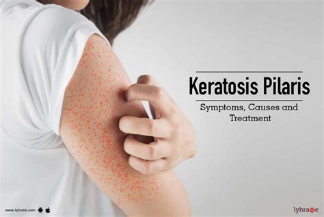Keratosis Pilaris Symptoms Causes And Treatment By Dr Nivedita