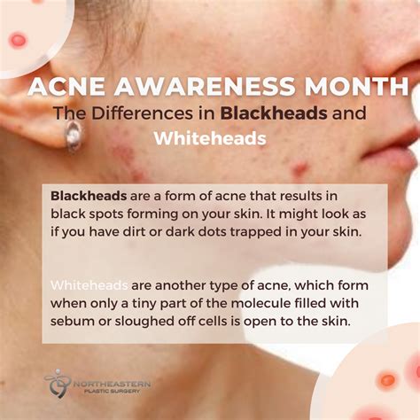 Whats The Difference Between Blackheads And Whiteheads Healthy Skin