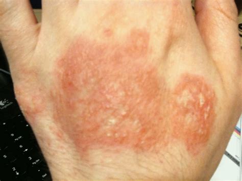 Bumps On The Underneath Of Your Tongue Ulcer Red Rash On Face Hands