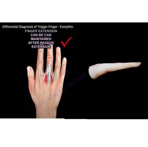 Differential Diagnosis Of Trigger Finger —