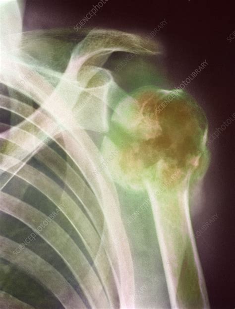 Bone Marrow Cancer X Ray Stock Image M1340440 Science Photo Library
