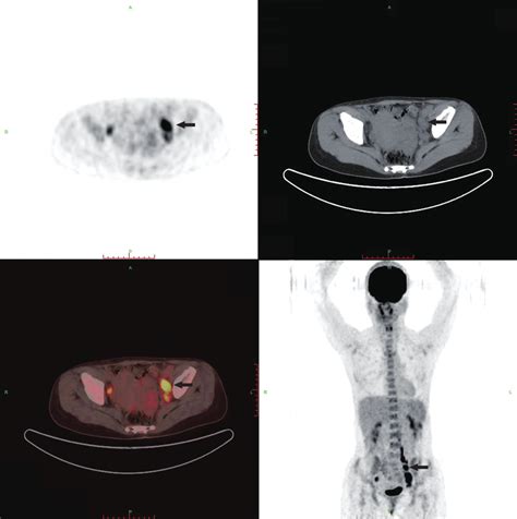 Petct Scan Of The Pelvic Lymph Node The Arrows Indicate Download