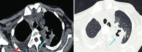 A Axial Mediastinal And B Axial Lung Window Images Showing