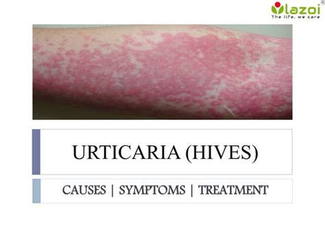 Urticaria Hives Causes Symptoms And Treatments Ppt