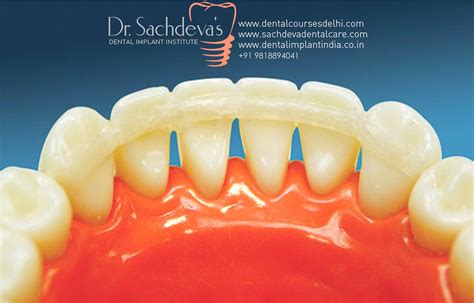 Mobile Teeth Solution With Splinting Dr Sachdeva Dental Clinic Delhi