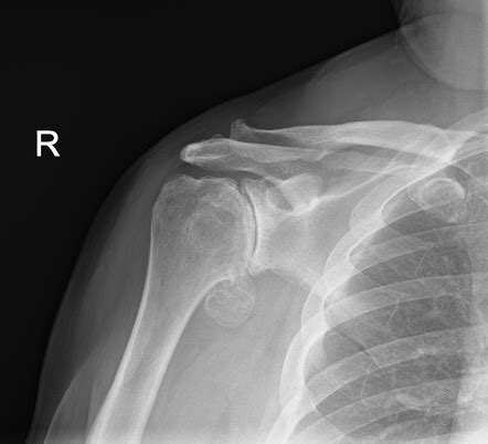 Osteoarthritis Of The Shoulder Radiology Reference Article Radiopaedia Org