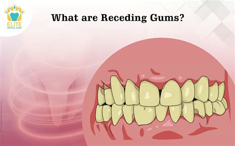 What Are Receding Gums Elite Dental Care