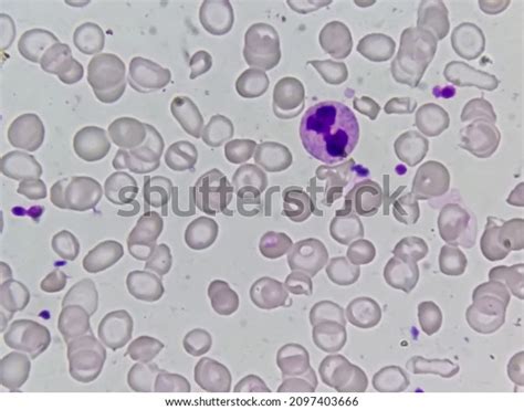 Hereditary Hemolytic Anemia Hemoglobin E Hb Stock Photo 2097403666