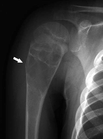 8 Unicameral Bone Cyst 5 Year Old Male With Pathologic Fracture And