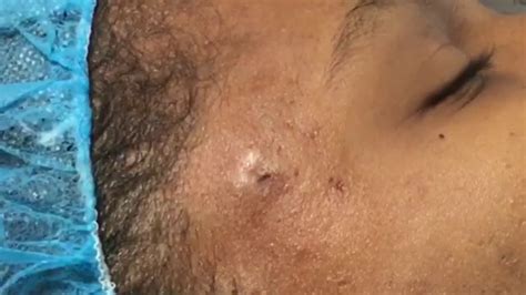 Cyst Removal New Client Blackhead Popping