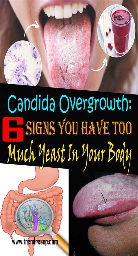 Candida Overgrowth 6 Signs You Have Too Much Yeast In Your Body