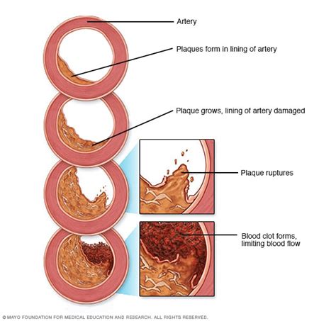 Coronary Artery Disease Symptoms And Causes Mayo Clinic
