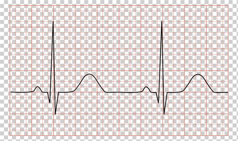 Electrocardiography Qrs Complex Sinus Rhythm Heart Arrhythmia Heart