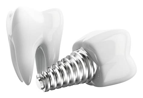 Dental Implants - Platinum Dental Group