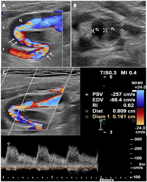 Preoperative Carotid Duplex Ultrasound A There Is Turbulence White