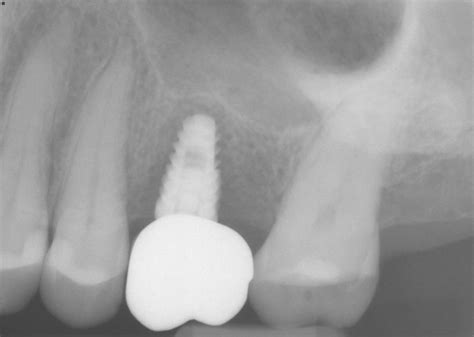 Dental Implant Failure After 8 Months Your Thoughts