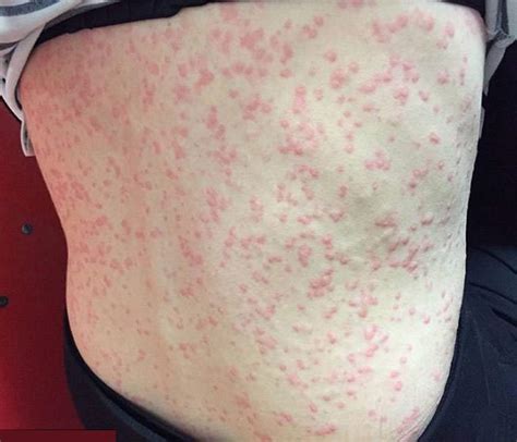 Hives As Related To Symptoms And Manifestations Pictures