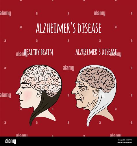Alzheimer Disease Dementia Memory Loss Brain Damage Medicine Health