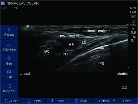 Ultrasound Guided Brachial Plexus Block My XXX Hot Girl