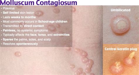 Molluscum Contagiosum Rosh Review Pediatrics Eore Dermatology Nurse