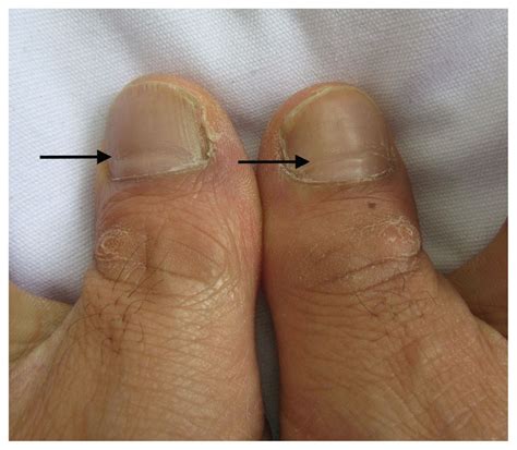 Causes Of Mees Lines Mees Lines Medicalopedia As The Nail Grows