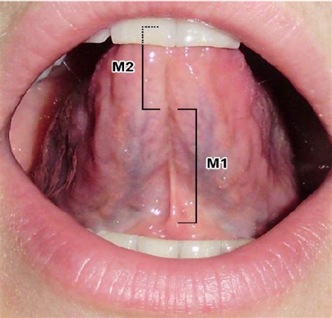 Pdf Clinical Analysis Of Proposed Classification Of The Lingual Frenulum By Index And