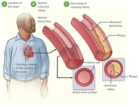 Coronary Heart Disease | Concise Medical Knowledge
