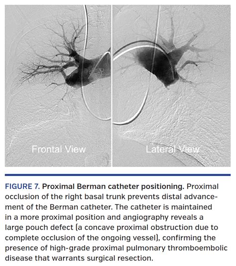 Optimal Technique For Performing Invasive Pulmonary Angiography For