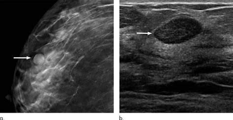 Six Month Follow Up Appropriate For Bi Rads 3 Findings On Mammography