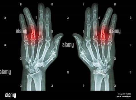Fracture Shaft Of Proximal Phalange Of Ring Finger Film X Ray Both
