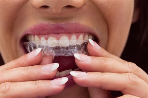 6 Things You Should Know About Invisalign