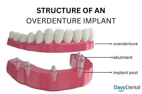 Snap On Dentures Vs All On 4 Dental Implants A Comprehensive Guide