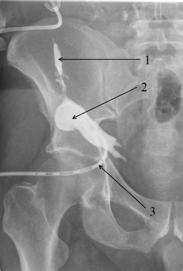 Subcutaneous Fat Abscess Fistulography 1 Sinus Tract Leading To The