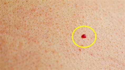 Do You Have Red Spots On Your Skin Heres What They Mean Find The