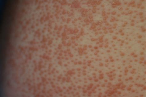 Pityriasis Rubra Pilaris A Rare Inflammatory Dermatosis Bmj Case Reports
