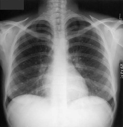 A Chest Radiograph Shows Multiple Small Calcific Nodule Open I