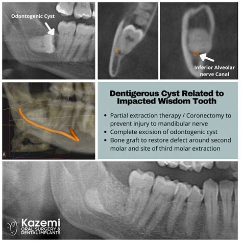 Odontogenic Dentigerous Tooth Cyst Impacted Wisdom Tooth Coronectomy