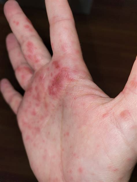 Pediatrician Warns About Hand Foot And Mouth Disease Winnipeg Free Press