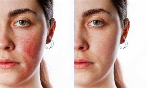 Rosacea Before And After