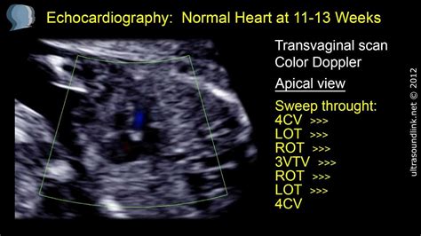 Fetal Heart At 12 Week 31 Clips Of The Fetal Echo Compilation Youtube