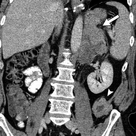 Merkel Cell Carcinoma A Primer For The Radiologist Ajr