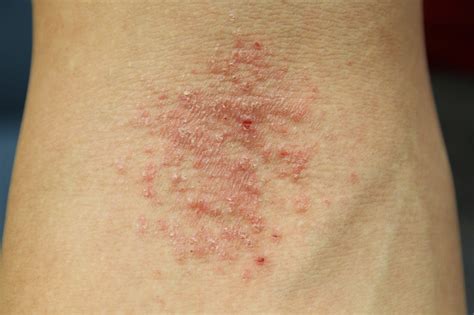 Tips Curing Disease Eczema Skin Causes Symptoms Types Diagnosis
