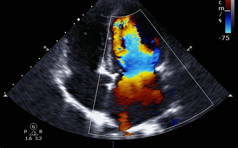 Transcranial Doppler Ultrasound Manhattan Cardiology