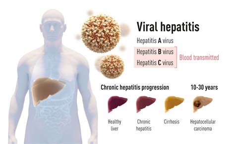Por Qu El Premio Nobel De Medicina Es Para El Descubrimiento De La Hepatitis C