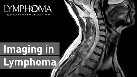 Hodgkins Lymphoma Radiology